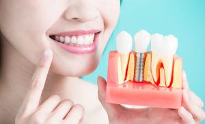 dental implants